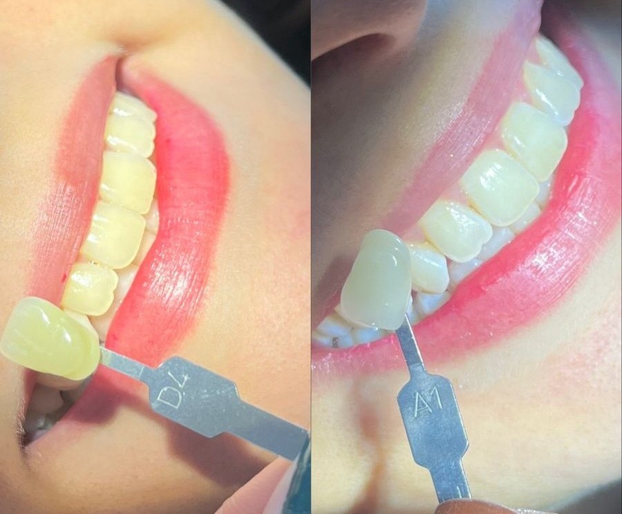 Resultado Antes e Depois - Clareamento