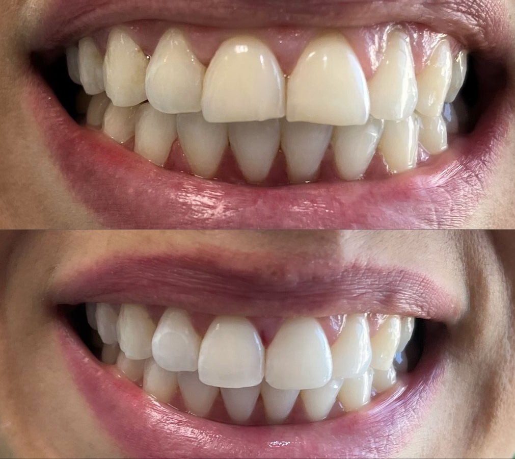 Resultado Estética Dental