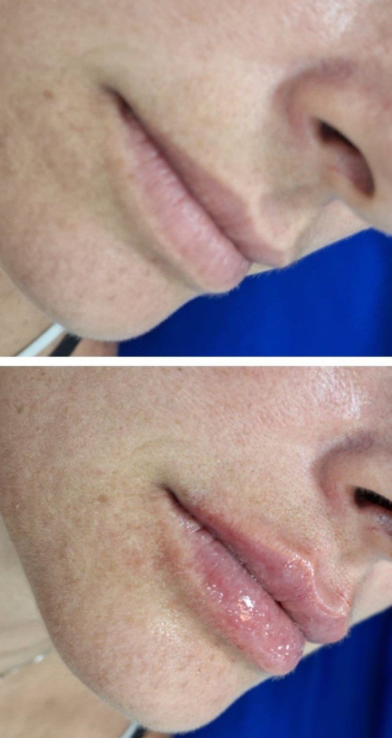 Resultado Preenchimento Labial